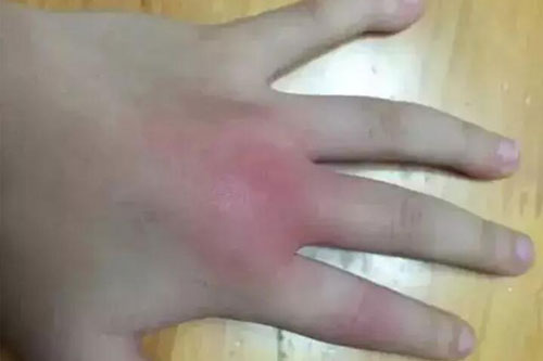 被蜈蚣咬傷了怎么辦？蜈蚣咬傷后如何處理？